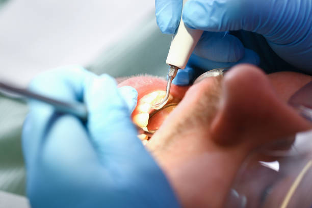Best Knocked-Out Tooth (Avulsed Tooth) Treatment in Oakdale, PA